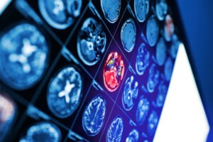 Brain Bleed From Car Accident – Causes & Symptoms